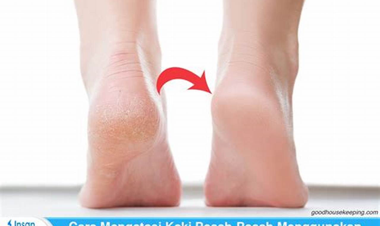 Cara Mengatasi Kaki Pecah Pecah